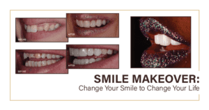 How To Fix a Gummy Smile (It's Easier Than You Think!)